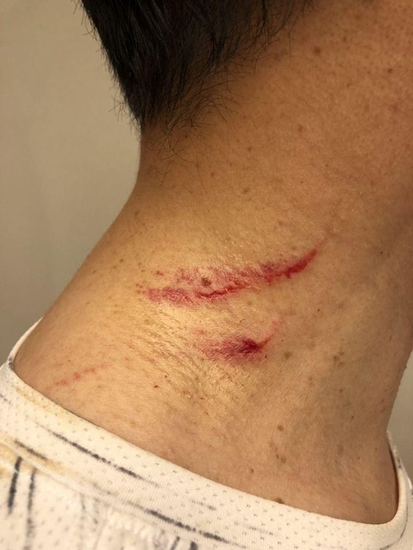 지난 10일 허익범 특검팀의 2차 소환조사를 받고 귀가하던 중 폭행을 당한 김경수 경남도지사의 상처 / 사진 : 기동민 더불어민주당 의원 SNS