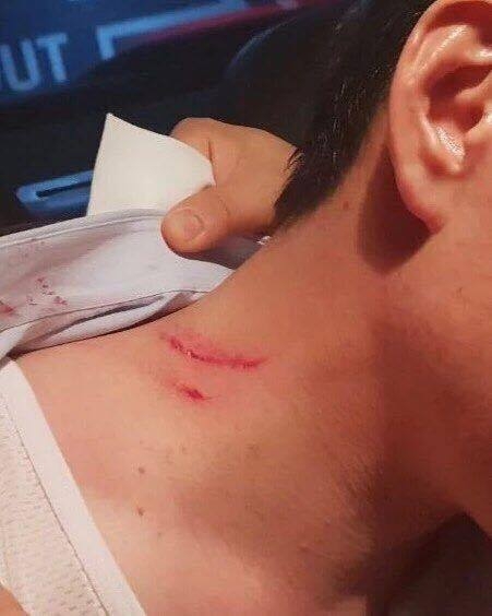 채길태 씨가 공개한 김 지사의 상처 / 사진 : 채길태 씨 SNS