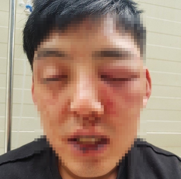 차오름은 양호석에게 폭행을 당해 안와골절, 코뼈함몰 등의 상처를 입었다고 주장했다. <사진 : 차오름 씨 제공>