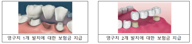 영구치 발치 개수별 보철치료 보험금